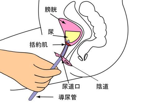 成人尿道插管图片视频,成人尿道插管操作步骤及注意事项解析